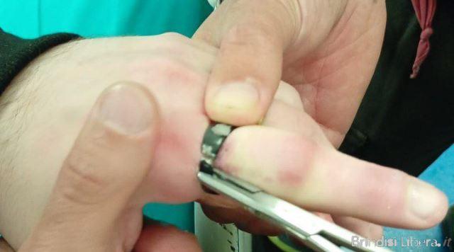 Brindisi, Vigili del Fuoco al Perrino: rimosso con il Dremel un anello da un dito gonfio