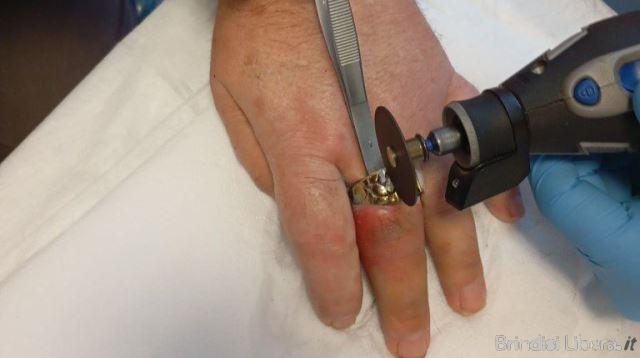 Brindisi, intervento dei Vigili del Fuoco al Pronto Soccorso del Perrino per la rimozione di un anello
